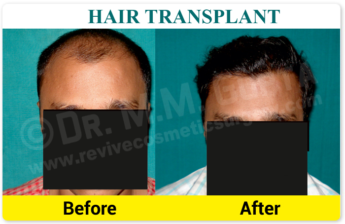 Best Hair Transplant Clinic in Lucknow | Plastic & Cosmetic Surgery