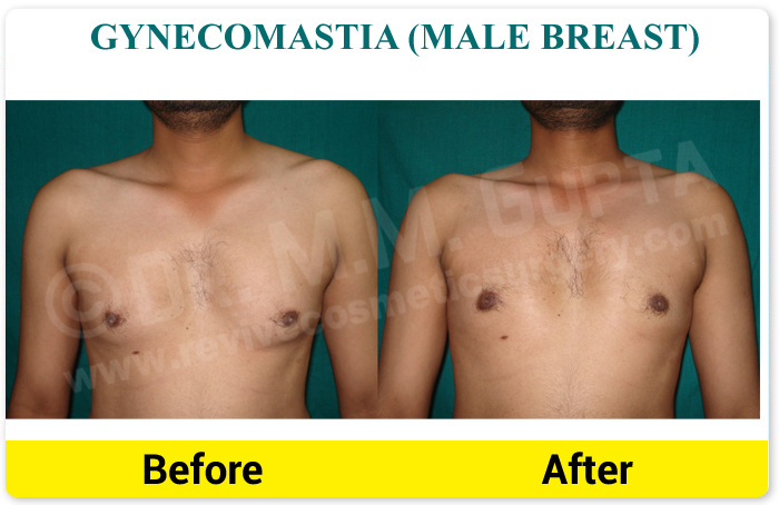 Fat Grafting, Fat Transfer, Lipofilling